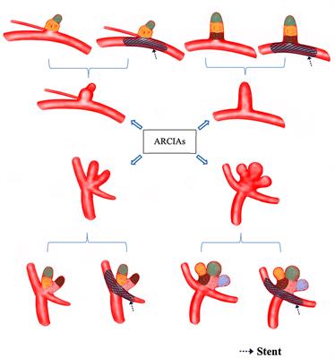 Microcatheter-guided compartment packing of acutely ruptured complex intracerebral aneurysms (ARCIAs): Preliminary experience and technical note